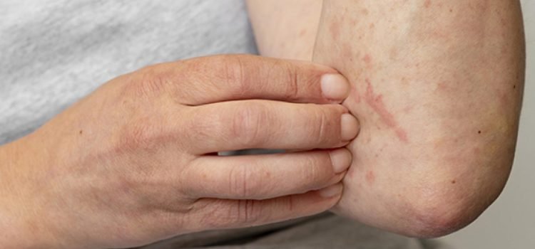 A la baja los contagios de Mpox en Quintana Roo