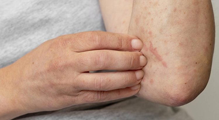A la baja los contagios de Mpox en Quintana Roo
